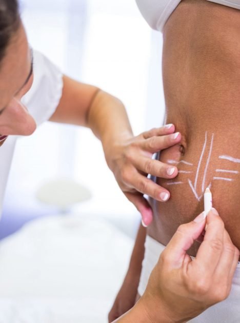 surgeon-drawing-lines-womans-abdomen-liposuction-cellulite-removal-min